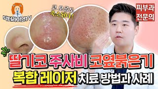 딸기코/주사비/코옆 붉은기🍓👃 복합 레이저 치료 방법과 사례 (feat. 코모공도 축소된다고?!)