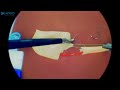 adult pyeloplasty laparoscopic training