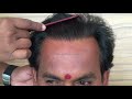 amazing density hair transplant - pioneer clinic