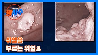 위암을 부르는 위염♨ 소화불량을 그냥 넘기면… MBN 230719 방송