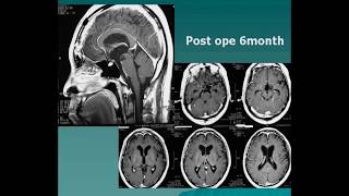 Combined approach for craniopharyngioma