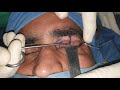 Revolutionary Ptosis Surgery using Palmaris Longus Tendon Sling| Prof. Dr. Sudhir Mehta| Part 6