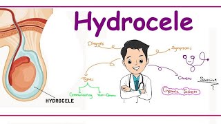 WHAT IS HYDROCELE