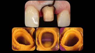 Ultradent Ultrapak Gingival Retraction Cord - How To Use - DENTBEAR