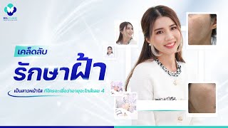 รักษาฝ้า | EP.26 |  วิธีการดูแลปัญหาฝ้า ผิวหน้าดูสดใสขึ้น ที่ใครจะเชื่อว่าอายุใกล้เลข 4 | BSL Clinic