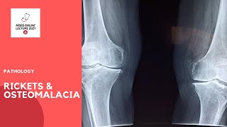 RICKETS AND OSTEOMALACIA; a vitamin D deficiency state.