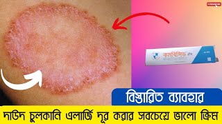 combicid cream এর কাজ কি | কমবিসিড ক্রিম ব্যাবহার করার নিয়ম | দাউদ দূর করার উপায় | দাউদ চুলকানি