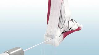 MEDHOLD achilles reconstruction using y knot rc with tape and crossft knotless