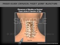 Image Guide Cervical Facet Joint Injection