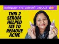 Must try serum on acne prone skin | How to get rid of acne | How to remove pimple #acne  #skincare