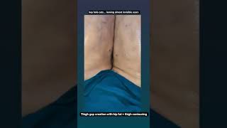 Thigh Liposuction to Create Inner Thigh Gap #thighcontouring #shorts