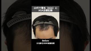 【10代薄毛治療記録】一年でここまで変わりました！ #aga治療 #薄毛