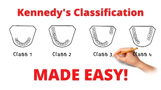 Kennedy's Classification and Applegate's rules