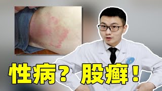 大腿根发黑、瘙痒难耐，是性病还是股癣？得了股癣怎么办？