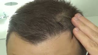 FUE Hair Transplant \u0026 PRP: Day 105 Post Op Recovery (Answering Comments)