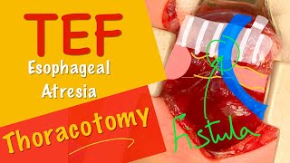 Neonatal Open Repair of Esophageal Atresia & Tracheo-esophageal Fistula EA/TEF. Dr Tamer Ashraf