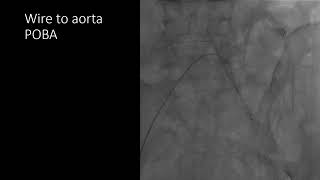 傑克老師CV man-#common Iliac artery CTO 導管治療髂動脈慢性全阻塞