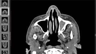 Bilateral mandibular condylar dislocation