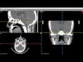 'DYNAMIC' CT SCAN. CT SCAN PNS in 'MOTION' made simple. Dr.Ajinkya Kedari.