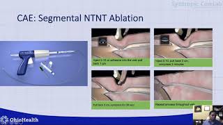 Venous Reflux: Role of Endovenous Ablation_Kolluri_Peripheral On Demand