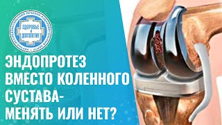 🦿 Эндопротез коленного сустава - менять или нет?