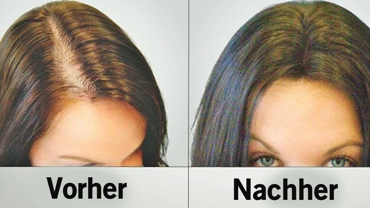 Diese Natürlichen Hilfsmittel Stoppen Haarausfall Und Lassen Die Haare ...