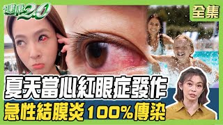 女星眼睛刺痛血管破裂 當心夏天紅眼症發作！急性結膜炎100%傳染 醫師教戰防範守則！ 健康2.0 20240727【完整版】鄭凱云 陳瑩山 鄭聖甫 許瓊月 芳瑜 潘瑋翔 @tvbshealth20