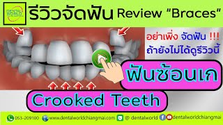 EP.53 #รีวิวจัดฟันซ้อนเก Crooked teeth #BracesReview #Crowding #จัดฟันเชียงใหม่ #chiangmaidentist