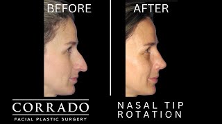 What is the Ideal Angle for Nasal Tip Rotation? | Rhinoplasty and Nasal Tip Surgery