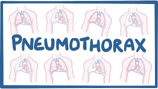 Pneumothorax - causes, symptoms, diagnosis, treatment, pathology