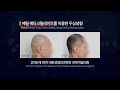 두상성형으로 납작한 뒤통수 정수리 이마 고민 해결할 수 있어요 본시멘트를 이용한 부산두상성형 찾는다면