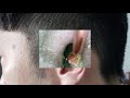 한달에 한번 귀지제거 다음달에 뵙겠습니다. earwax removal once a month.