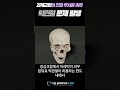 과개교합이 진짜 무서운 이유 턱관절통증 소리 tmj 유발