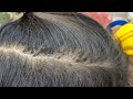 Remove thousand lice from black hair - Getting out all head lice from hair