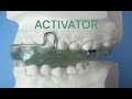 Activator Appliance Therapy's Impact in Orthodontics