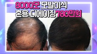 60대 고도탈모 대량모발이식 8000모 모발이식비용 780만원