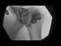 Glenohumeral Shoulder Intraarticular Steroid Injection under Fluoroscopy