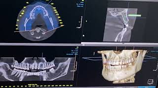 KAVO (DEXIS) OP3D Pro CBCT implant planning case Hawkesbury Dentistry