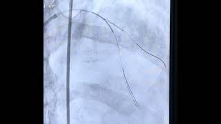 Case 11:-LAD- D1 bifurcation angioplasty,mini crush technique step by step