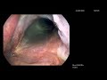 tuberculosis of the voice box tuberculous laryngitis