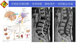 腦下垂體功能低下，腎上腺機能不全， 長期服用類固醇，骨質疏鬆，腰椎骨折，神經壓迫疼痛