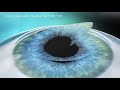 femto lasik with visumax and mel90 bladeless lasik