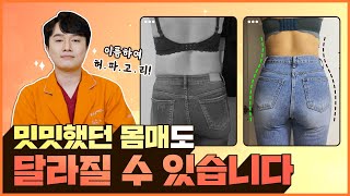 👀비키니몸매완성~ 얇고 굴곡진허리 20대 女고객님|#서울365mc병원 정진묵원장 #허파고리