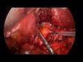 Difficult Cholecystectomy - Cholecystostomy Tube