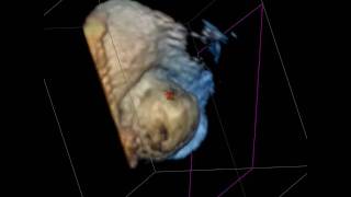 Multifenestrated Pfo Aneurysmal