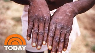 How To Identify A Monkeypox Rash: Symptoms To Look Out For