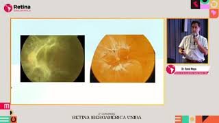 Ttos. retinopatía diabética, terapia génica para recuperar visión. Valoraciones. II Congreso Retina