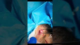 HD Graphic Painful Facial Cyst Abscess Pop and Removal!