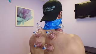 Benefits of cupping Los Angeles Best Chiropractor Dr. Ash The Chiro Guy