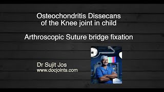 Osteochondritis Dissecans Arthroscopic suture bridge fixation